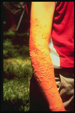 The sting of the
red fire ant can be very painful. 
