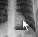 I think my xray has
been photoshopped, because I have done a few photoshops in
my time and also because of some of the pixels